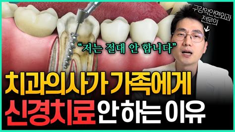 치과의사들이 말하지 않는 신경치료의 진실 - YouTube