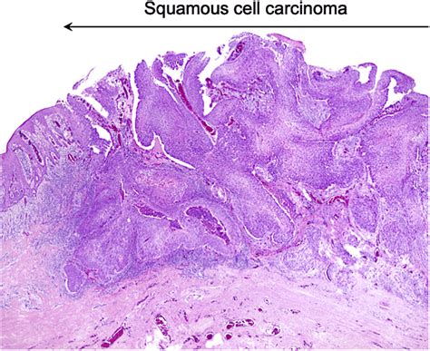 Histologic Examination Of The Resected Specimen With Hematoxylin And