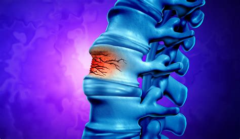 Kyphoplasty A Solution For Painful Vertebral Compression Fractures