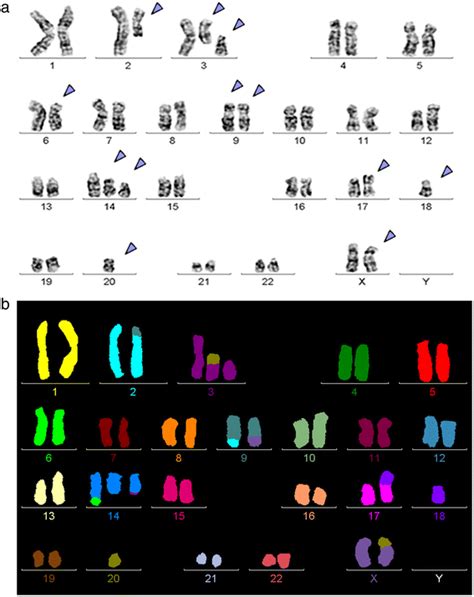 A High Complex Karyotype Involving Eleven Chromosomes Including Three