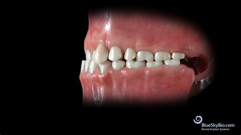 Anterior Crossbite Skeletal Or Functional Youtube