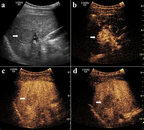 P Hcc In A 33 Year Old Patient A Gray Scale Ultrasound Showed A