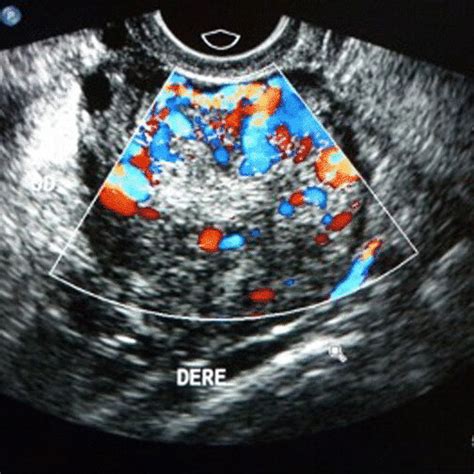 Ultrasound And Ct Scans Of The Patient A B Endovaginal Ultrasound We