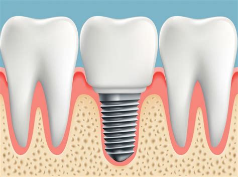 Microthreaded Dental Implants Preserve Crestal Bone Dentistry Co Uk