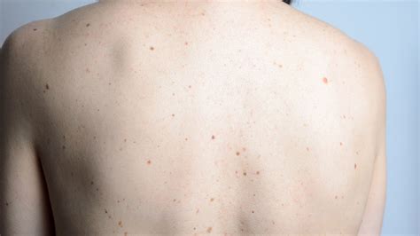 Do more moles mean more problems? Not so, says new study