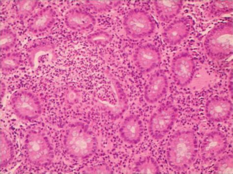 Histopathology Of Ulcerative Colitis In Patients With Intestinal Ebv