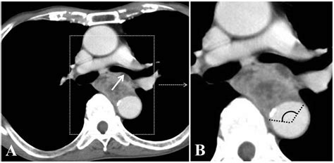 Esophageal Cancer X Ray