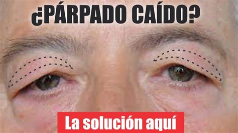 PÁRPADO SUPERIOR CAÍDO Blefaroplastia superior y levantamiento de