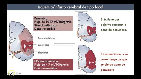 Enfermedad Vascular Cerebral Parte Youtube