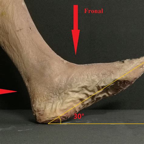 Sagittal Ct Image Of The Ankle Joint R Upper Surface Of The