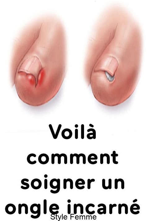 Voilà Comment Soigner Un Ongle Incarné Check More At