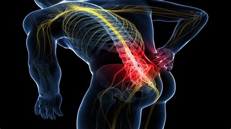 Come Curare La Sciatica Una Guida Passo Passo Mdm Fisioterapia