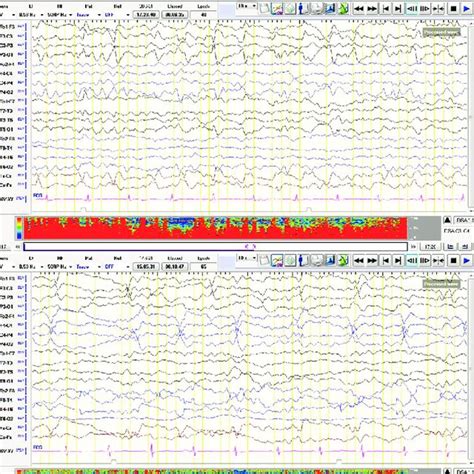 A Eeg Showing Periodic Epileptiform Discharges Involving Left