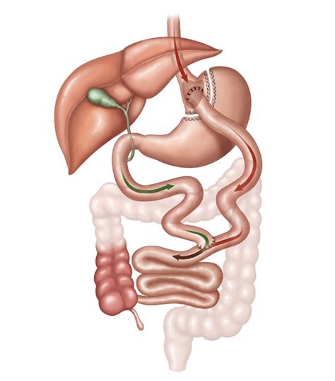 Cirurgia Bariátrica | Bypass Gástrico | Dr. Thales Delmondes Galvão