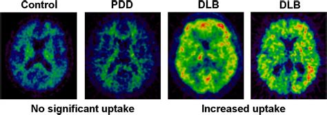 Imaging Approaches To Parkinson Disease Journal Of Nuclear Medicine