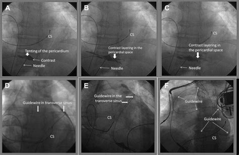 How To Learn Epicardial Intervention Techniques In Electrophysiology