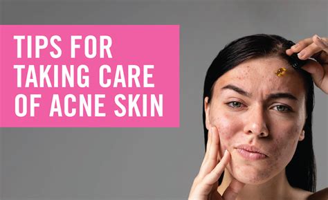 tips   care  acne skin momma