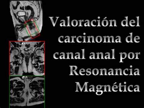 Figure from VALORACIÓN DEL CARCINOMA DEL CANAL ANAL POR RESONANCIA MAGNÉTICA Semantic Scholar