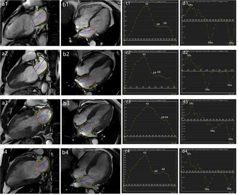 Cardiovascular Magnetic Resonance Myocardial Feature Tracking For The Determination Of Left