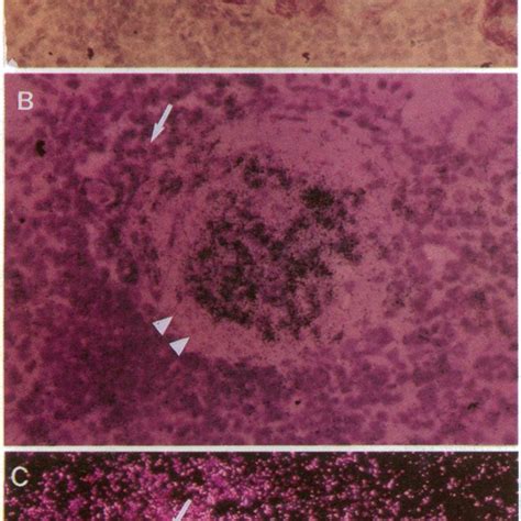 A Light Microscopy Photomicrograph Showing A Fibrocellular Crescent