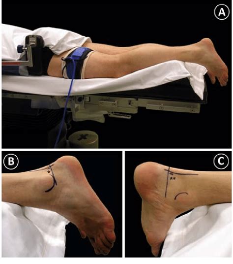 A Patient Positioning For Arthroscopic Subtalar Arthrodesis A