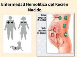 Enfermedad hemolítica del recien nacido EcuRed