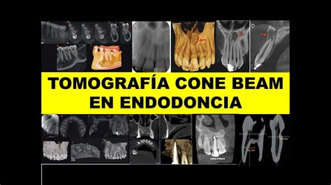 TOMOGRAFÍA CONE BEAM EN ENDODONCIA YouTube