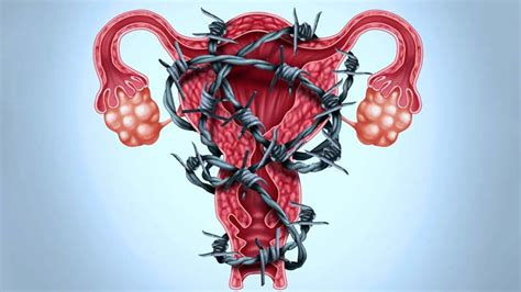 Endometriose Causas E Sintomas