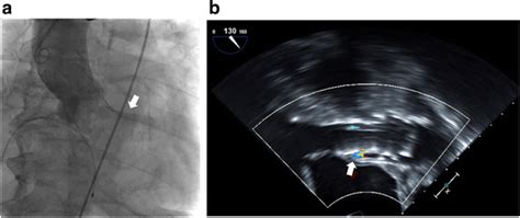 Immediate Post Procedural Findings A The Aortogram Revealed Mild Download Scientific Diagram