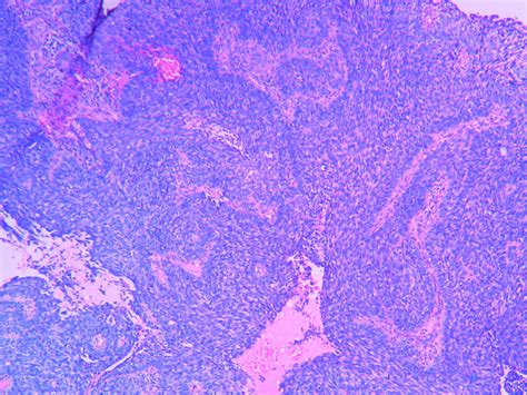 Basaloid Squamous Cell Carcinoma Histopathology Guru