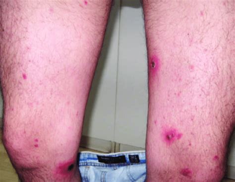 Erythematous Papules And Ulcerated Lesions On The Lower Limbs Download Scientific Diagram