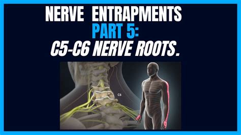 Nerve Entrapments Part 5 C5 C6 Nerve Root Youtube