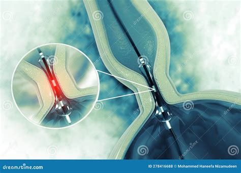 Procedimiento De Angioplastia Con Stent En Vena Stock De Ilustraci N