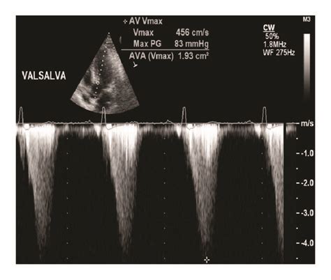 Transthoracic And Transesophageal Echocardiographic Findings A