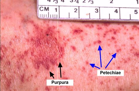 Aplastic Anemia - Causes, Signs, Symptoms, Life Expectancy, Treatment