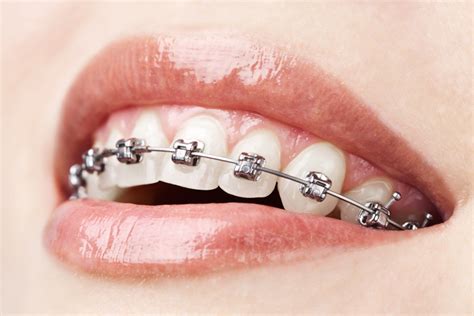 Invisalign® Vs Braces Pros And Cons One Centre Dentistry