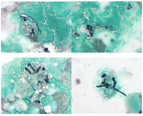 Microscopic Slide Of Histoplasmosis Sputum Samples Were Positive For