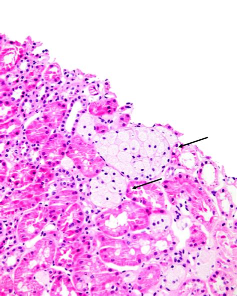 Foam Cells Histology | Hot Sex Picture