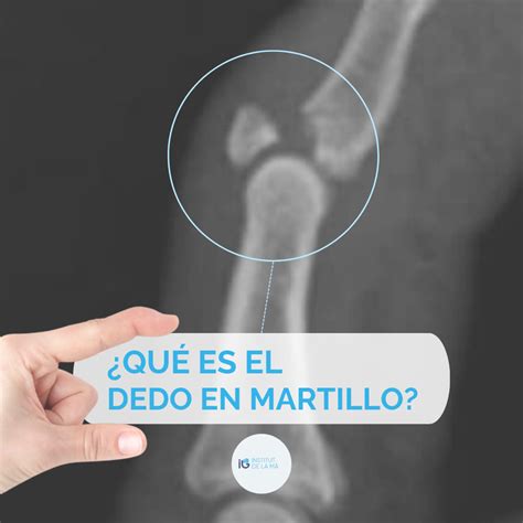 Dedo en martillo diagnóstico y tratamiento institutdelama es