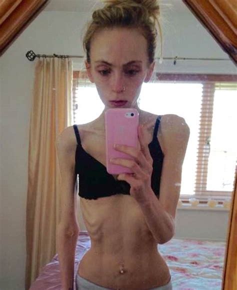 Desperate Mother Shares Shocking Photos Of Her Anorexic Daughter