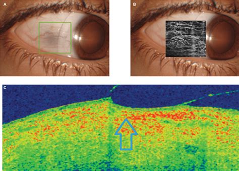 Oct Analysis Of The Peripheral Bearing Of The Scleral Contact Lens With