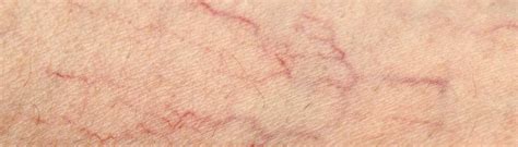 Spider Veins Treatment Kansas City & Marshall, MO | Missouri Vein Specialists