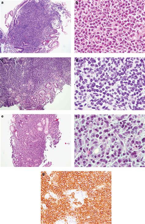 Examples Of Gastric Biopsy Findings In Mzl Malt A Low Magnification Download High