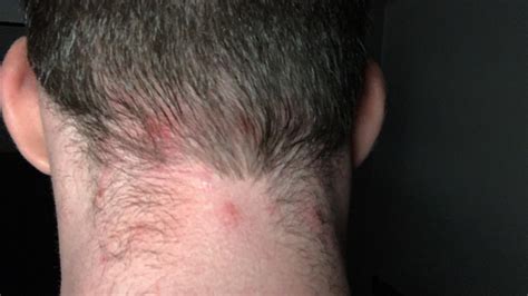 Painful Solid Red Bumps Back Of Head And Neck Hair Looks Like That