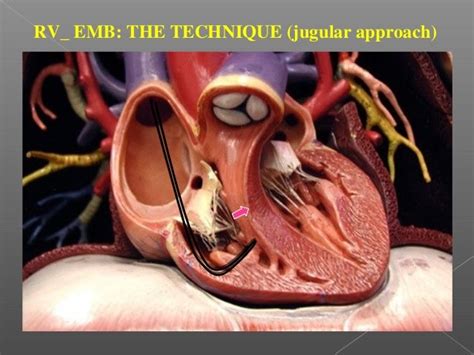 Endomyocardial Biopsy