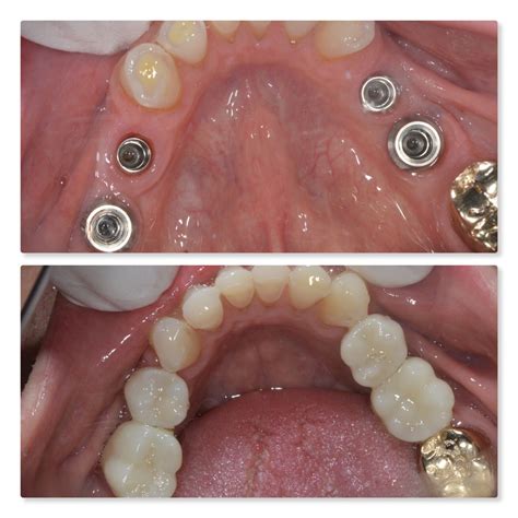 Preventing Over Eruption And Drifting Following Tooth Loss Dental