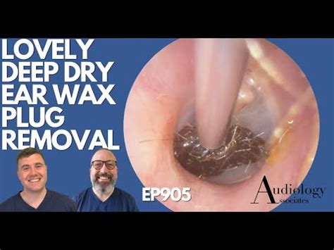 Lovely Deep Dry Ear Wax Removal Ep Youtube