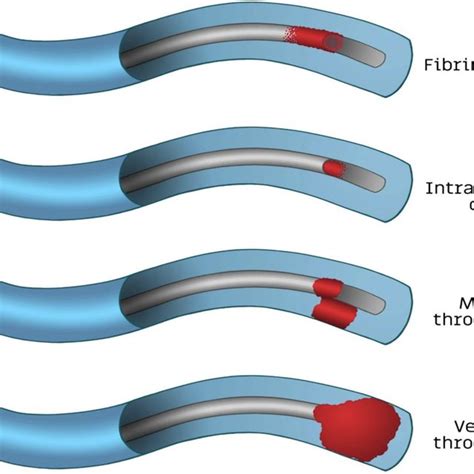 The Main Types Of Catheter Related Thrombotic Occlusions Adapted From Download Scientific