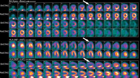 Ischemic Heart Disease Noninvasive Imaging Techniques And Findings