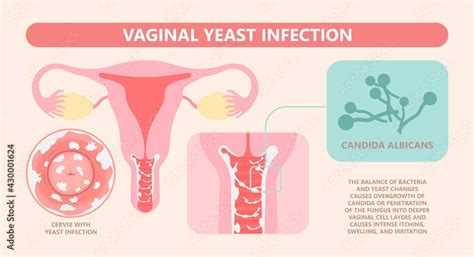 Douche Vagina Odor Clean Blood Flora Ectopic Yeast Bacterial Pelvic